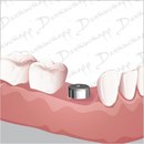 дантистофф импланты. дантистофф импланты. имплантация зубов дантистофф. дантистофф импланты. ).